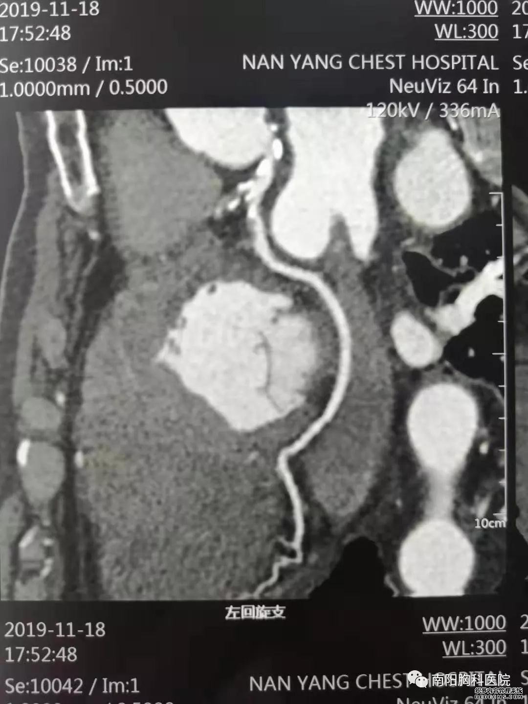 CT和MRI如何看正常及异常冠状动脉，高清图谱请收好！_冠状动脉_CT_MRI_医脉通